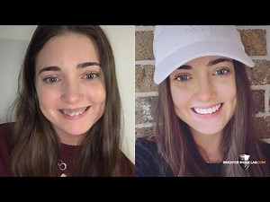 Incredibil™ Dental Veneers! See Kindergarten Teacher Save $30,000 by BIL!