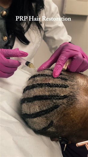 Nobody talks about the moment you realize your edges aren’t coming back… 👀 The ponytails get looser. The braids stop hitting the same. And suddenly you’re Googling “why are my edges thinning?” Before you panic — there are options. PRP (Platelet-Rich Plasma) treatments use your body’s own growth factors to stimulate dormant hair follicles and help regrow thinning edges. Yes… your edges can grow back. If you’ve been noticing thinning around your hairline, this might be the sign you’ve been waitin