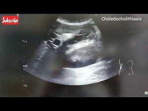 Ultrasound video showing Choledocholithiasis with dilated IHBR