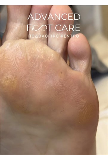 Ήξερες ότι ο πόνος κατά τη βάδιση στο μετατάρσιο μπορεί να κρύβει πολλούς μικρούς κάλους; 👣 Μικροί αλλά επώδυνοι… και δύσκολα αφαιρούνται σε ένα απλό πεντικιούρ. ✨ Με εξειδικευμένο καθαρισμό, αφαιρέθηκαν ένας προς έναν και η ανακούφιση ήταν άμεση! 📍 Η σωστή αποφόρτιση είναι το κλειδί για να μην επιστρέψουν. Ακολούθησε μας για να μαθαίνεις πώς να φροντίζεις σωστά τα πόδια σου 💆‍♀️ #reels #ποδια #καλοι #podology