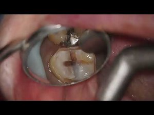 Occlusal Veneer Preparation on Upper Left First Molar | Microscope Dentistry Tutorial