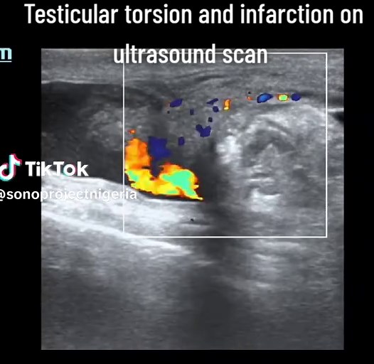 Testicular Torsion on Ultrasound: Quick Diagnosis Tips