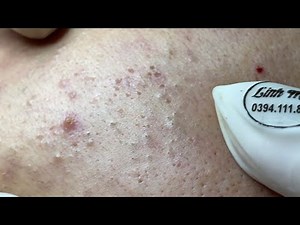Acne treatment for Spa Linh Mun 2023 #014