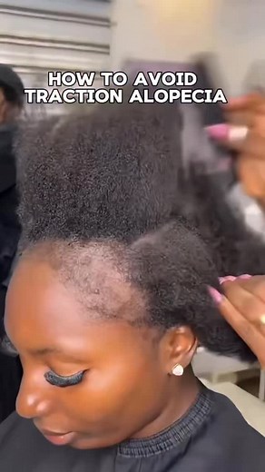 1.4K views · 46 reactions | Let’s talk about traction alopecia one of...