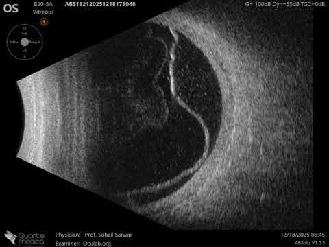 20 MHz Annular Ophthalmic Ultrasound ABSolu, Exudative retinal detachment with shifting turbid subre