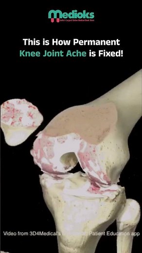 Understanding Knee Replacement Surgery: Step-by-Step Guide & Recovery Tips | Medioks