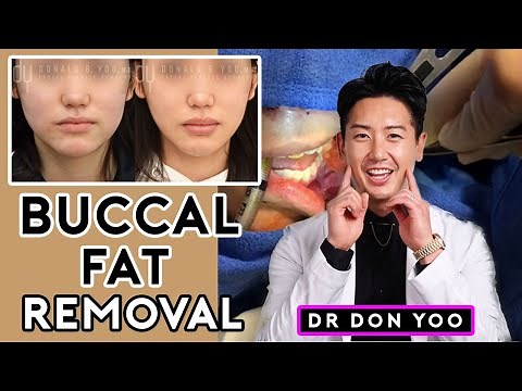 All About Buccal Fat Removal Surgery and Recovery - Dr. Donald B. Yoo