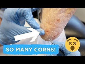 SUPER SATISFYING CORN REMOVAL!