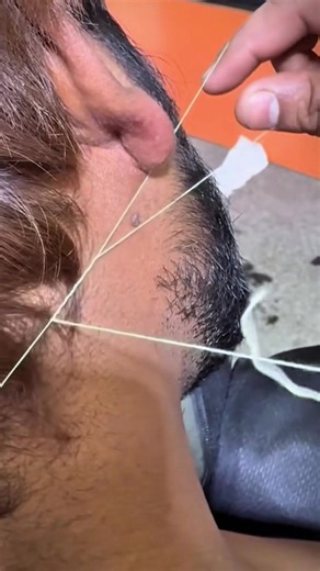 Funny Skin Tag Removal Using Threading Technique