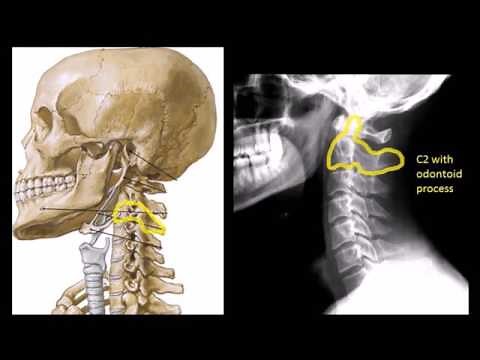 Approach to Cervical spine xrays