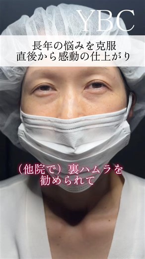 感動の仕上がり#美容 #整形 #クマ取り #目の下のクマ #若返り #ybc横浜美容外科 #イソセン