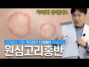 극심한 가려움의 고통! 원심고리홍반 치료방법 | 두드러기 다형홍반 아니에요 |연세에이엔비피부과 이해진 원장