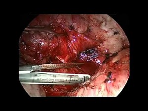 Left Lower VATS Lobectomy For Intrapulmonary Sequestration • Video • MEDtube.net