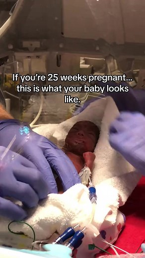 Still can’t believe it sometimes.. 🥺 #preemie #pregnant #25weekspregnant #25weeker #micropreemie #prematurebaby #preemiemom #prematurebirth | Nicu baby