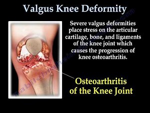 Valgus Knee Deformity - Everything You Need To Know  • Video • MEDtube.net