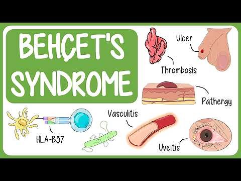 Behçet's Syndrome Visually Explained