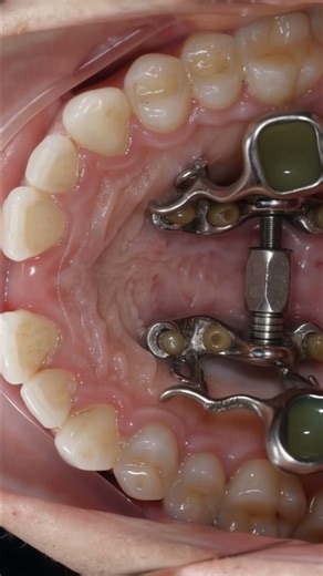 Parallel midpalatal separation with 3D guided piezo MARPE