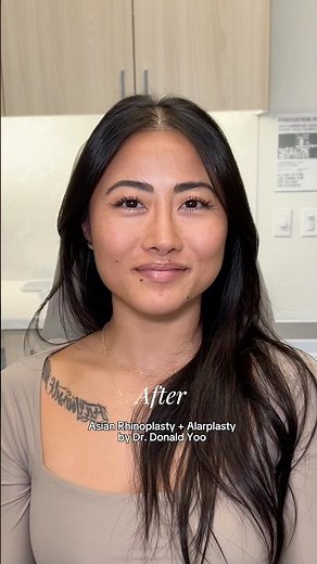 Asian Rhinoplasty #prettytoprettier