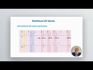 Masterclasses in Electrocardiography - Clinical Spectrum of High Degree Atrioventricular Blocks
