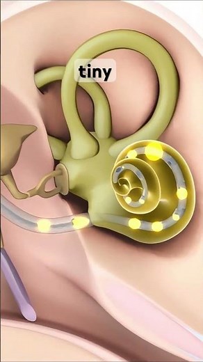 cochlear implant surgery #3dmedicalanimation #cochlearimplant #ears #coclea #cochlearimplantawarenes
