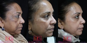 Cosmelan, Cosmelan Peel & Melasma Treatment NYC