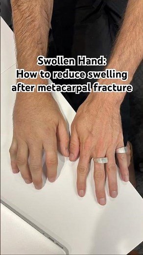 Hand Swelling from Metacarpal Fracture: What To Do #handswelling #handfracture #handtherapyexperts