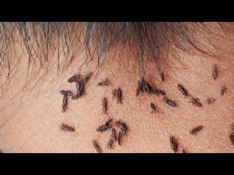 Getting out all hundred lice from short hair - Remove thousand lice from short hair | EP 15