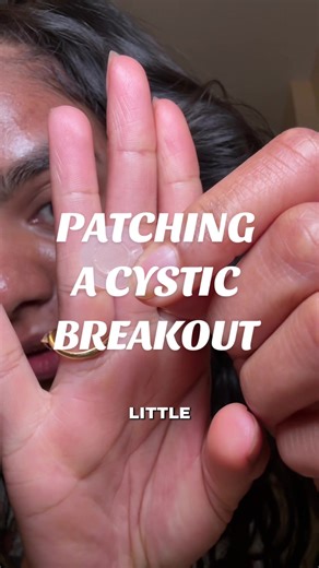 Effective Methods for Cystic Acne Treatment