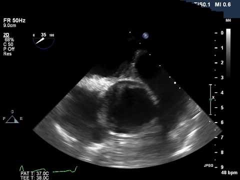 Vol.4 Issue 6 - Video 1: Transient Aortic Intramural Hematoma Complicating Transaortic...