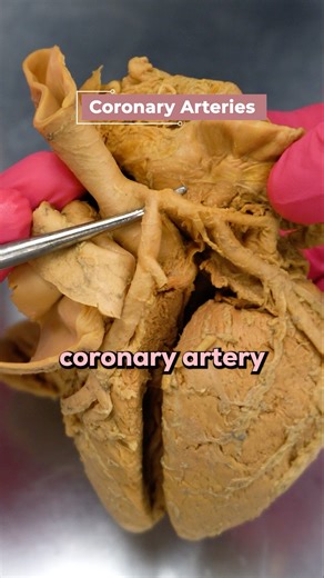 Institute of Human Anatomy on Instagram: "What Actually Causes a Heart Attack? 🫀💔 A heart attack (myocardial infarction) happens when blood flow to the heart muscle is blocked—starving it of oxygen. If not restored, that tissue dies. The Coronary Arteries The right and left coronary arteries supply blood to your heart muscle. "Coronary" means "crown"—they encircle the heart like a crown! They branch into smaller arteries feeding specific heart areas. The "Widow Maker" ⚠️ That big branch? The l