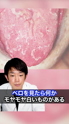 地図状舌の特徴と対処法