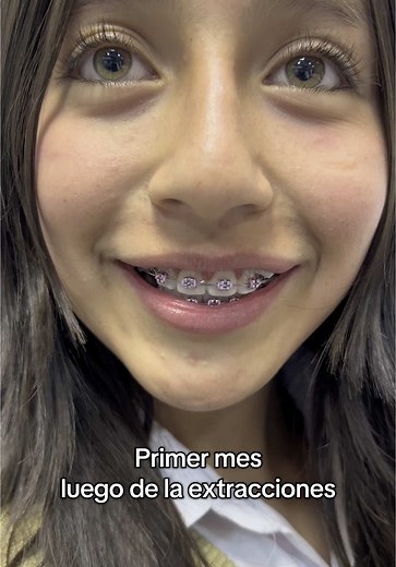 Extracción de cuatro primeros premolares en ortodoncia: Proceso y cuidados