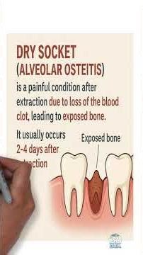 Dry Socket (Alveolar Osteitis) Causes, Symptoms & Management Day 2 | Must-Know Dental Exams Series