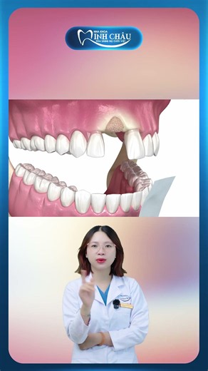 Ghép Xương Cấy Ghép Implant | Nha Khoa Minh Châu