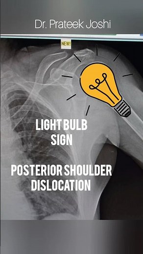 Posterior #Dislocation of #Shoulder Joint | Smooth Close Reduction Technique | Dr. Prateek Joshi