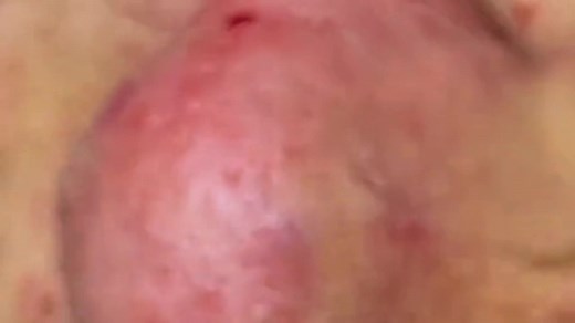 Part 8 🔥 #pimple #blackheart🖤 #blackheartsclub #acne #squeeze #satisfying #squeezepip ##squeeze #pop #黑头 #解压视频 #粉刺 #fyp #foryou #explore #satisfying #blackhea