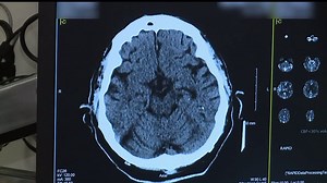 Stroke survivor thankful for procedure offered at Lancaster General Health that saved his life