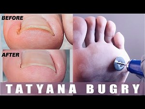 Transformation On Ingrown Toenail | Pedicure Using Disks Nail Drill | Russian, Efile Pedicure How To