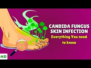 Candida Fungus Skin Infection – Causes, Signs and Symptoms & Effective Treatments
