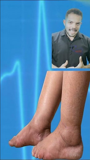 FLEBON (PYCNOGENOL) - WHAT IT IS FOR, HOW TO USE, HOW IT WORKS, SIDE EFFECTS - EVERYTHING ABOUT F...