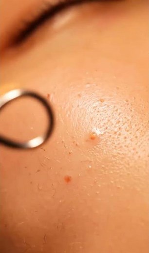 Extreme Macro Inner Cheek Extraction | Deep Sebum & Whitehead ASMR #asmr #skincare