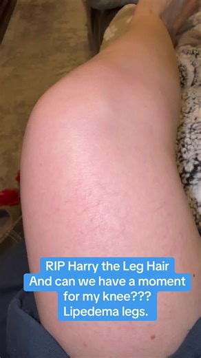 I am so curious see if the leg hair will grow back fast and more??? What an experiment! lol #lipedema