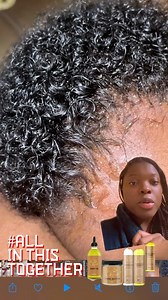 How to remove cradle cap safely and minimize hair fall This allows you to remove it without vigorously combing/scraping it out of the scalp. You also have the luxury if using 100% vegan, homemade product with clean and safe ingredients made with babies in mind follow @lachelbeaute for more tips! #hairgrowthoil #growhairfast #growhairfaster #cradlecap #cradlecapremedy #minoxidilalternative #alopeciatreatment #hairlossremedy #naturalremedyforhairgrowth #naturalhairlossremedy #ayurvedicherbsforhair