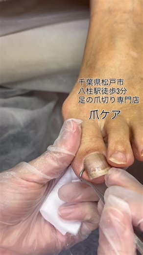 足の爪切り専門店 千葉県松戸市/まきで on Instagram: "爪ケアのみです。 他店でつけてた巻き爪ケアをオフして、 爪切りのみで様子を見ることに😌 —————————————————————— 足の爪切り専門店mimulus ミムラス 八柱駅/新八柱駅 徒歩2分 住所:千葉県松戸市金ヶ作24-1 (マンション名はご予約確定後お伝えします) 近くにコインパーキングがございます ◽︎トラブルケア対応サロン 素足美人を目指します✨ 何歳になっても自分の足で楽しく歩ける足を一緒に目指しませんか？😌 ——————————————————————— ◽︎menu◽︎ ,,,,,,,,,,,,,,,,,,,,,,,,,,,,,,,,,,,,,,,,,,,,,,,,,,,,,,,,,,,,,,, 2026年1月からの価格 •足すっきりケア¥11.000 爪、角質ケア、トリートメント •スタンダード¥8.000 爪ケア、角質ケア、トリートメントから 2つお選びください •足爪ケア(10本)¥5.500 •角質ケア ¥5.500 —-オプション—- ◯巻き爪ケア プレート1本 ¥5.500 