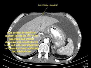 12-🎯👉FALCIFORM LIGAMENT AND LIGAMENTUM TERES(ROUND LIGAMENT)OUTLINED BY ASCITES🌺 CT ANATOMY