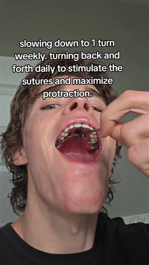 maxilla has noticeably moved forward and down. we need to continue the displacement. #bwython #marpe #maxilla #lm #airwayorthodontics