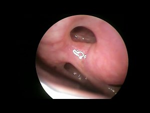 Dacryocystorhinostomy (DCR) Part 1