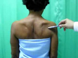 Muscle Atrophy And Rotator Cuff Tear • Video • MEDtube.net