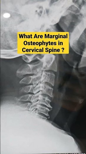 What Are Marginal Osteophytes in Cervical Spine ? Dr Sai Chandra.. Orthopaedic Surgeon In Hyderabad