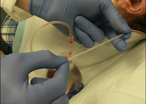 Post-Op Drain Management and Drain Removal